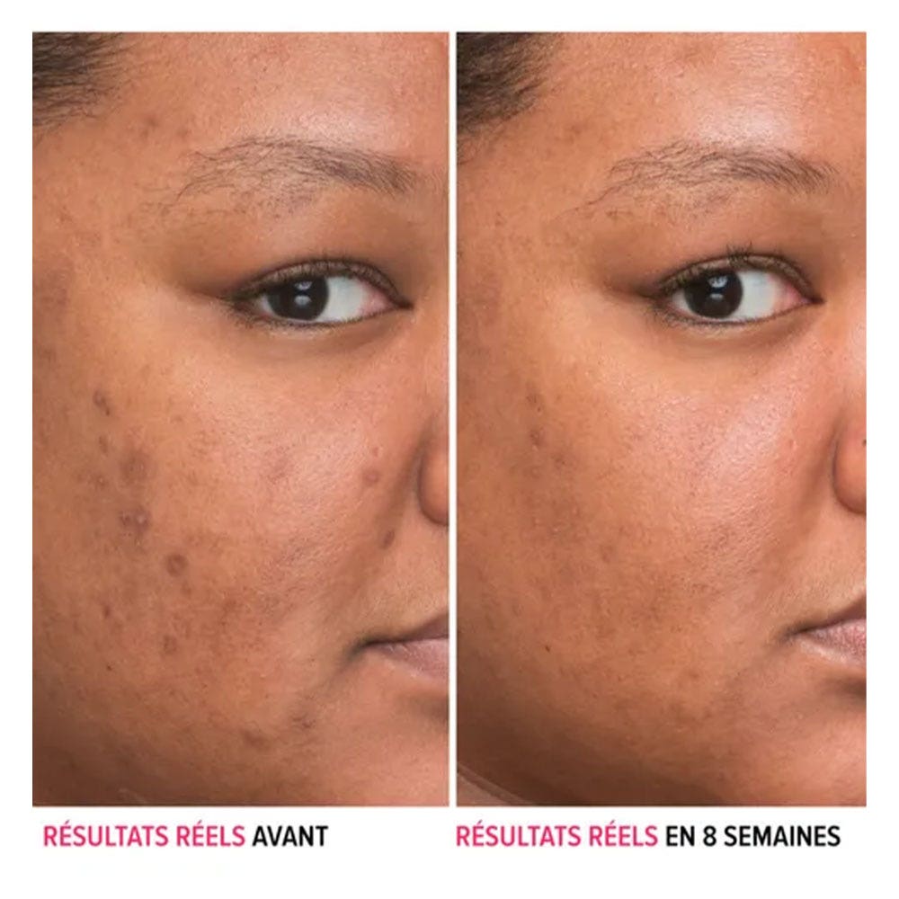 IT Cosmetics Bye Bye Dark Spots Anti-Spot Serum with Niacinamide for Hyperpigmented Skin 30ml (1.01 fl oz)