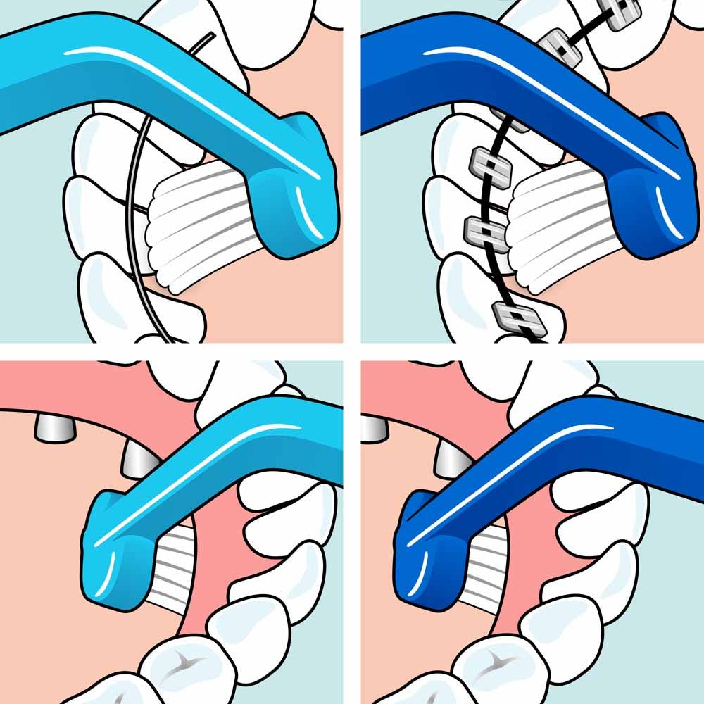 TePe Implant Orthodontic Special Toothbrush