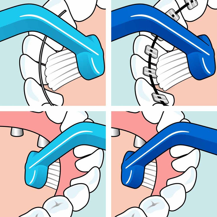 TePe Implant Orthodontic Special Toothbrush