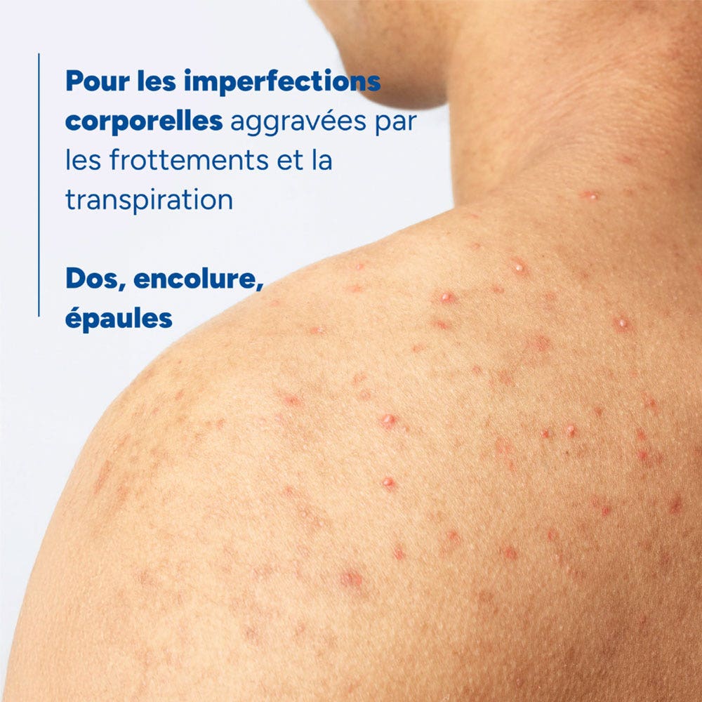 Ducray Keracnyl Drying body spray for spots 150 ml (5.07fl oz)