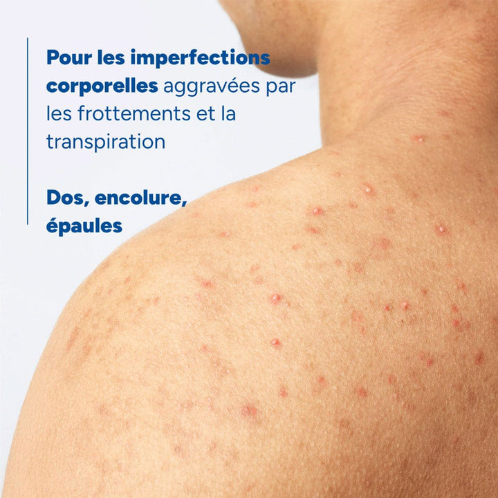 Ducray Keracnyl Drying body spray for spots 150 ml (5.07fl oz)